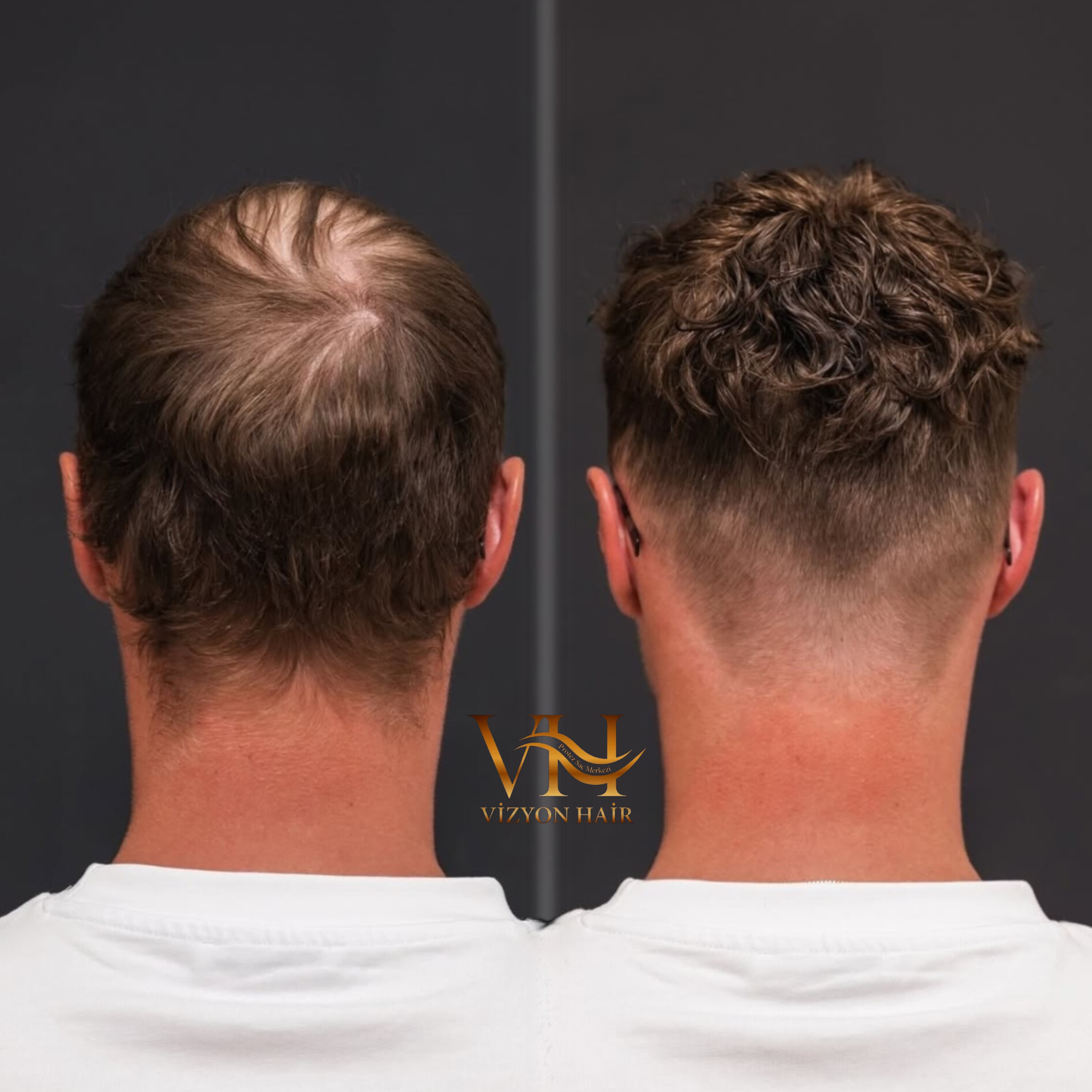 Uygulama sonrası doğal görünüm