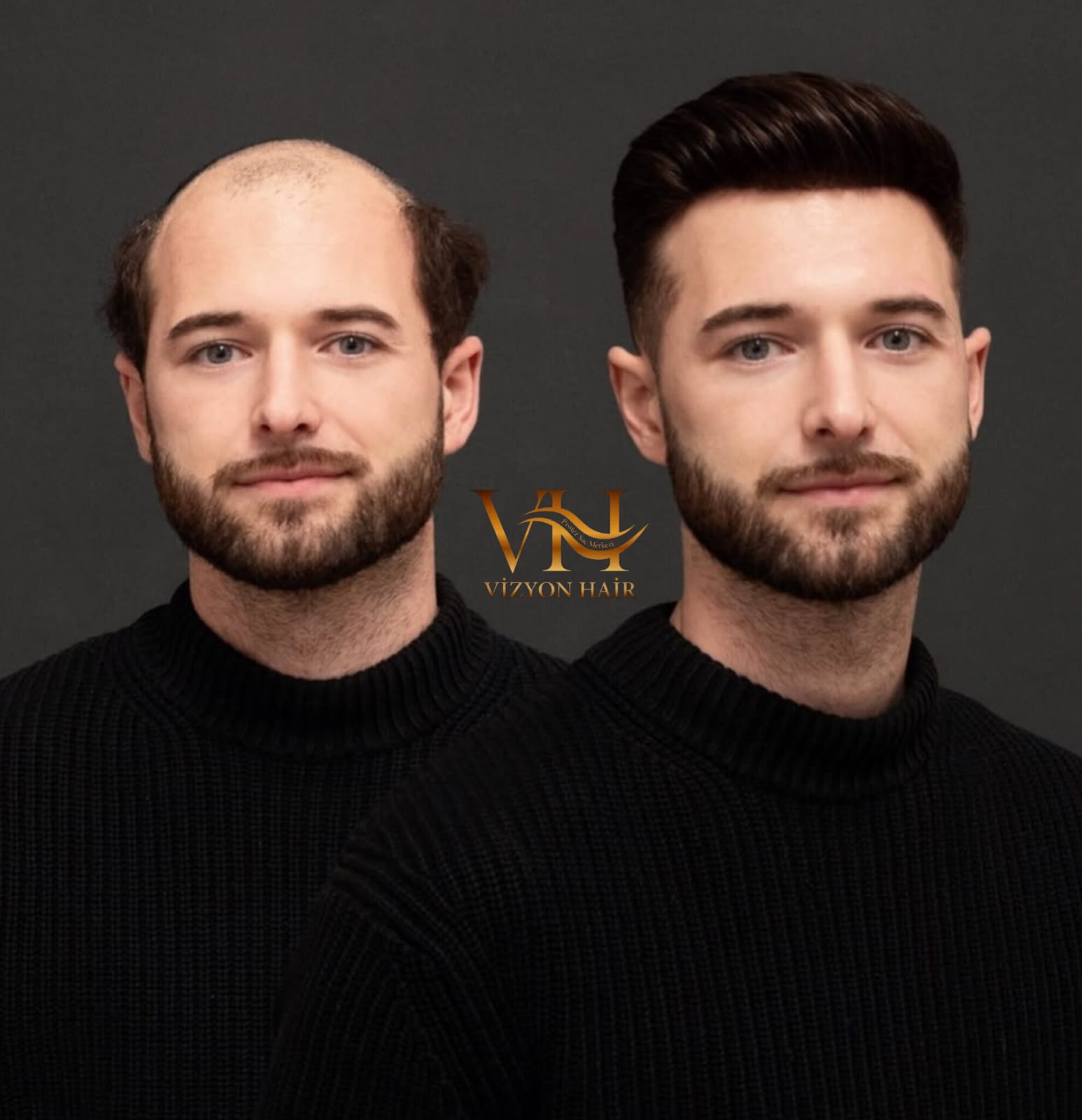 Vizyon Hair — doğal ön saç çizgisi
