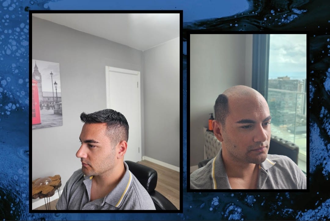 Uygulama sonrası — yandan görünüm